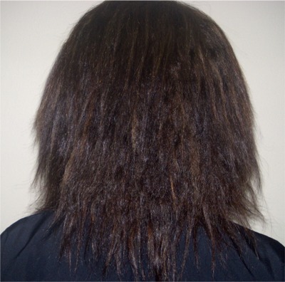 Chi Straightening System - Before Treatments