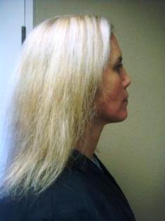 Before Hair Extensions, Side View