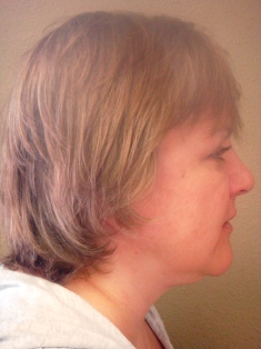 Before Hair Extensions, Side View