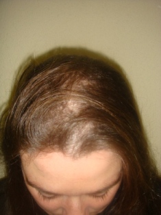Before Hair Extensions, Side View