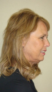 After Hair Extensions, Back View
