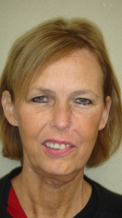 Before Hair Extensions, Front View