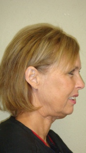 Before Hair Extensions, side view