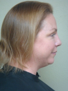Before Hair Extensions, Side View