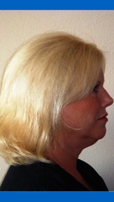 Before Hair Extensions, Side View